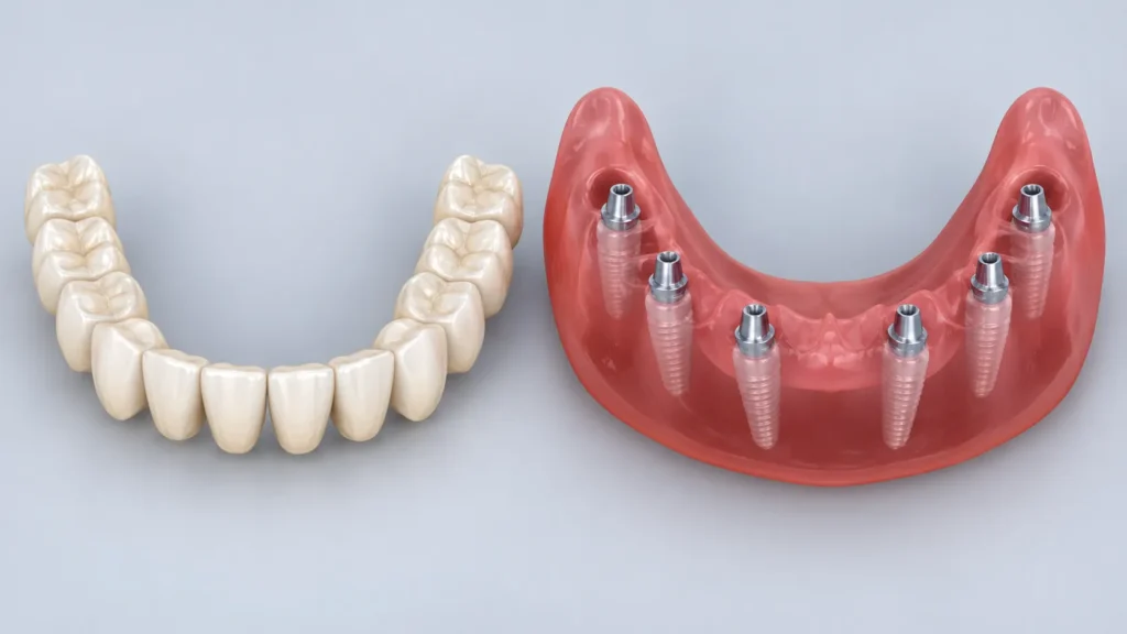 Implant All-on-6: cum decurge tratamentul și ce presupune o dantură fixă pe șase implanturi