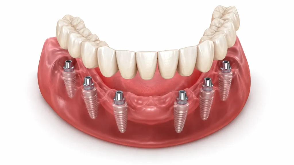 Lucrare fixă All-on-6 pe șase implanturi dentare la mandibulă, model 3D
