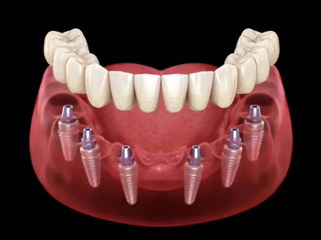 Poziția celor șase implanturi dentare pe arcada inferioară în protocolul All-on-6