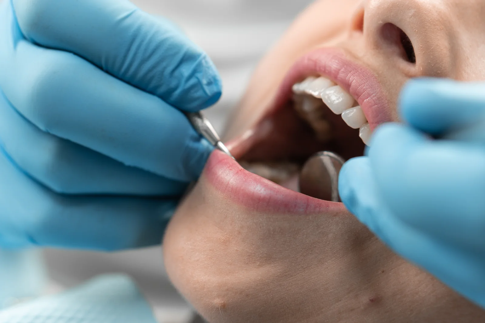 Intervenție de chirurgie orală la cabinetul MC Dental Implant Odobești