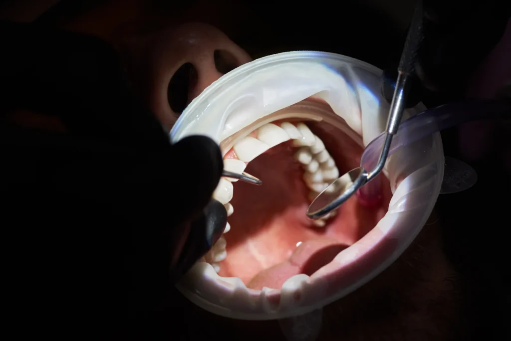 Nu aveți suficient os pentru implant? Ce înseamnă adiție de os și sinus lift