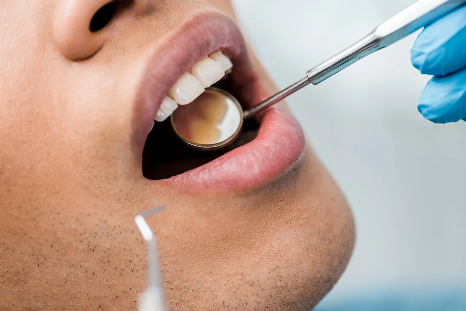 Igienizare dentară profesională la cabinetul MC Dental Implant Odobești