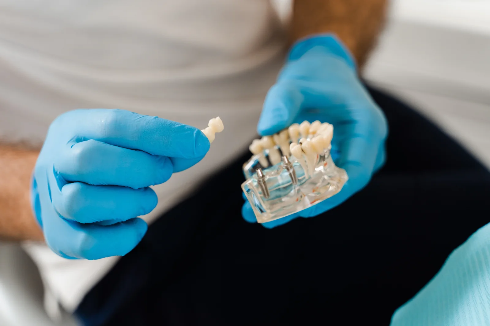 Model de arcadă cu implanturi dentare la cabinetul MC Dental Implant din Odobești