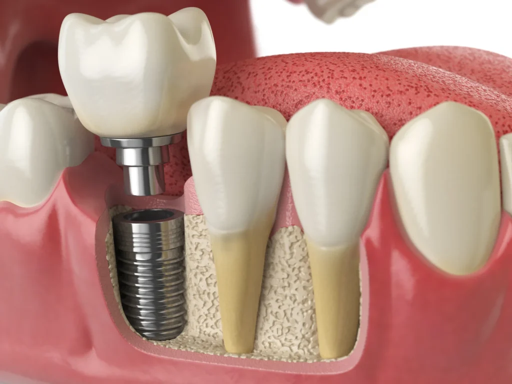 Cât costă de fapt un implant dentar: cele patru costuri care se adună
