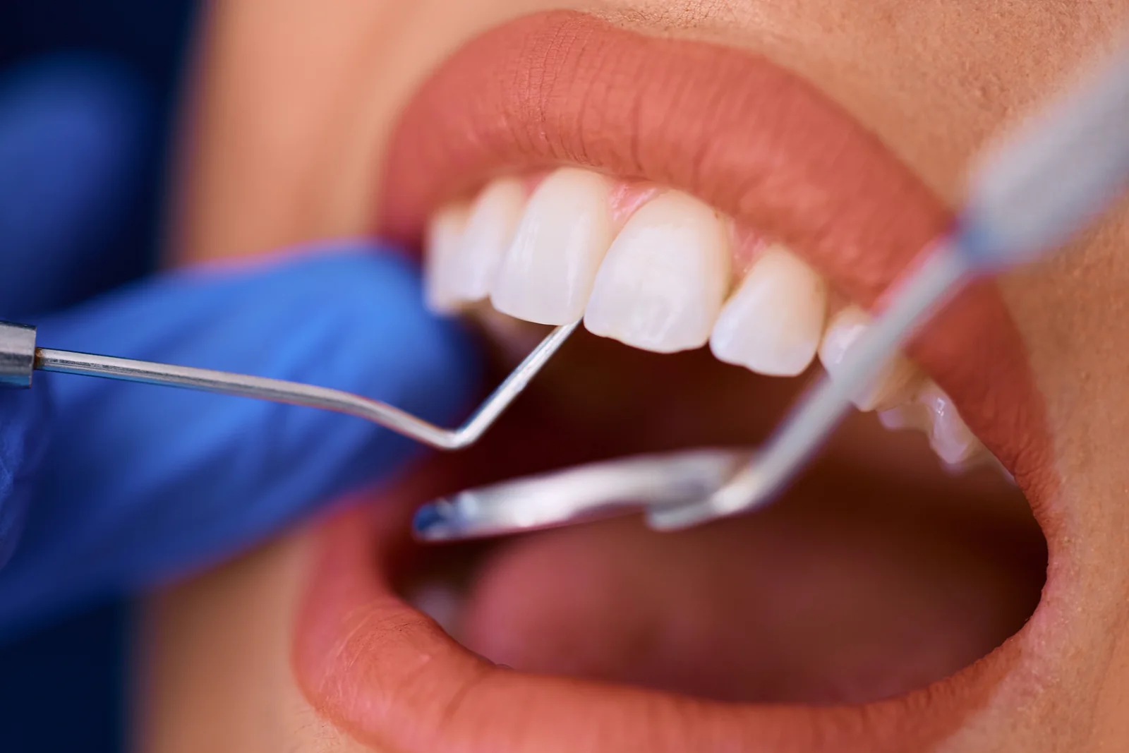 Detartraj și tratament parodontal la MC Dental Implant din Odobești