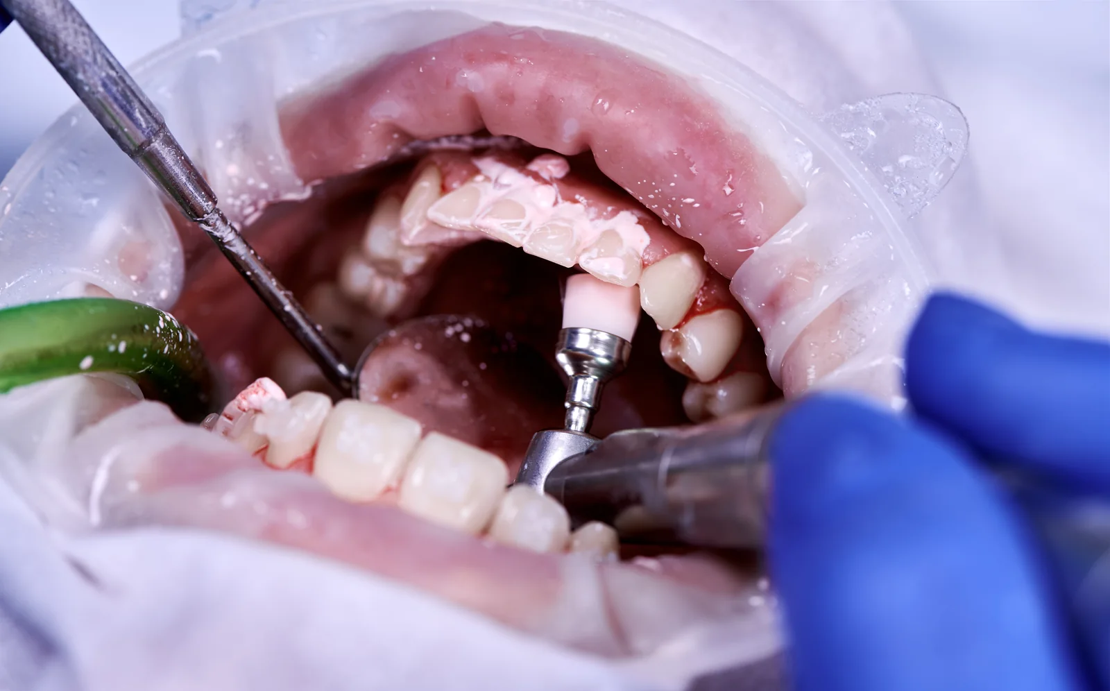 Realizarea unei obturații dentare la MC Dental Implant Odobești