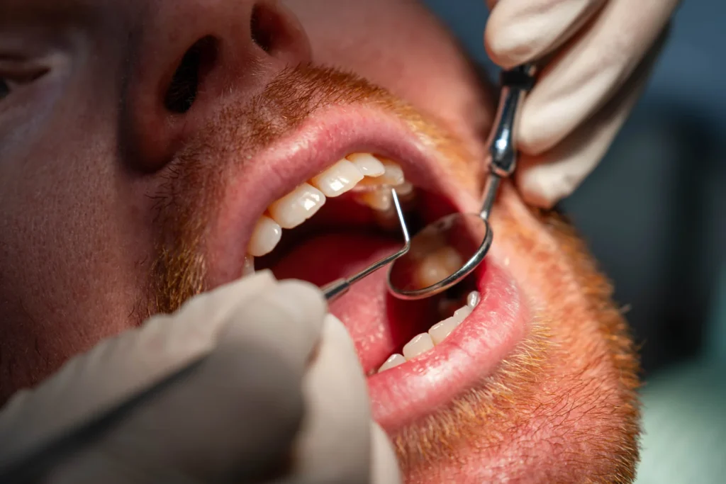 Cine nu poate face implant dentar: fumat, diabet, parodontoză